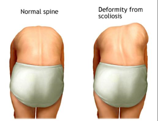 亞當式前彎檢查方法示意圖