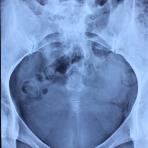 Coccyx Pain / Tailbone Pain