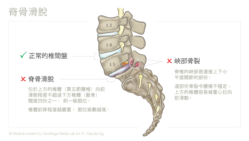 脊骨滑脫 